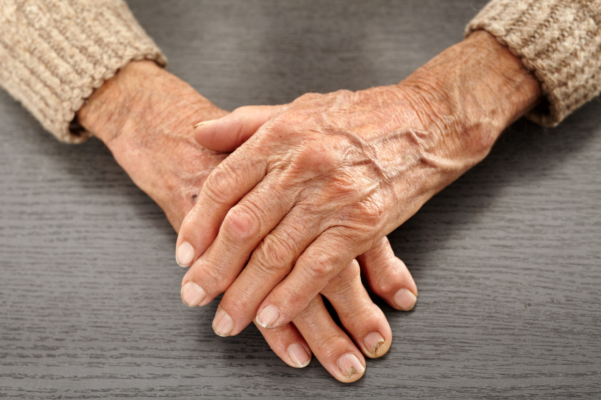 Revmatoidni artritis je lahko kar zahrbtna bolezen
